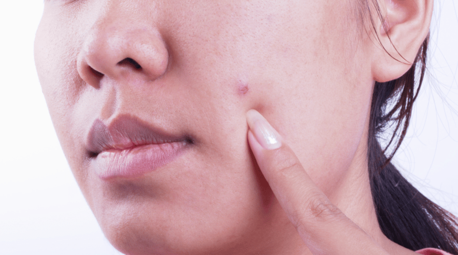 Can Skin Cancer Look Like A Pimple